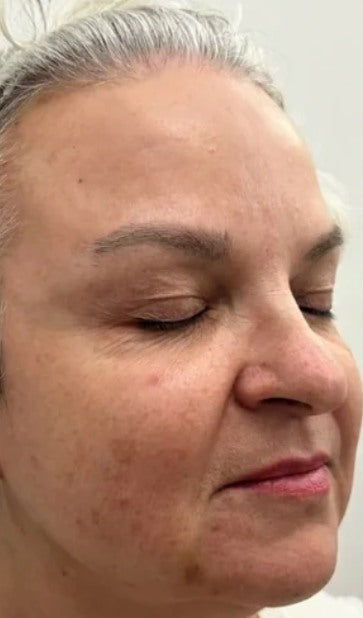 Antes: piel del rostro con arrugas marcadas